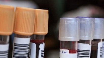Шефката на хематологията в Русе обвинена за  прелятата кръв с малария