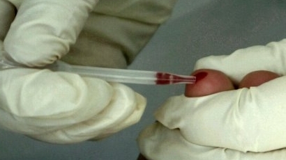 Болен от СПИН регистрираха в Плевен
