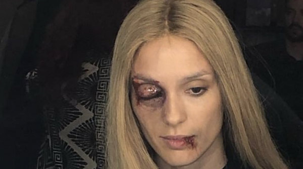 Луиза Григорова – Макариев си качи снимка с насинено и кърваво око и защити Юлиан Вергов