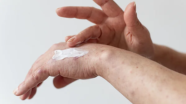 Дерматолози: Зимата е най-тежкият сезон за кожата