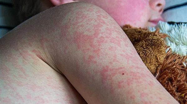 Седем нови случая на морбили у нас, общо заразените станаха 80